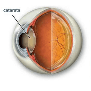 La vitamine C aide à arrêter le développement des cataractes